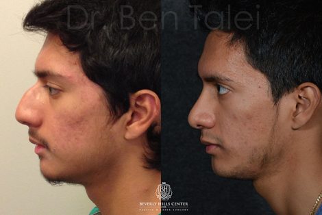 Beverly Hills Center Male Patient Before and After Minimally Invasive Closed Rhinoplasty and Septoplasty Procedure