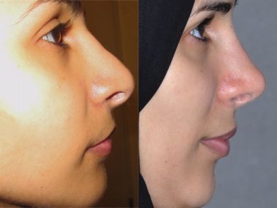 Revision 3rd Rhinoplasty - Right Side