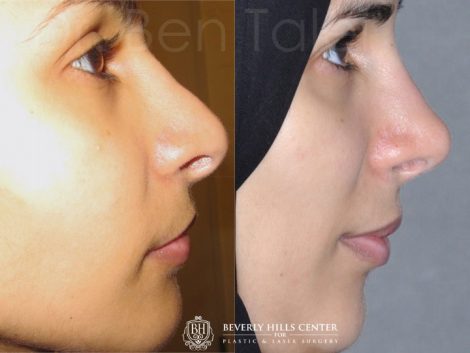 Revision 3rd Rhinoplasty - Right Side