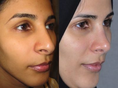 Revision 3rd Rhinoplasty - Right Side