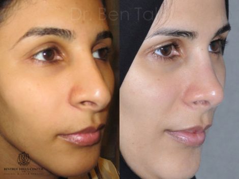 Revision 3rd Rhinoplasty - Right Side