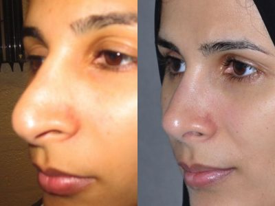 Revision 3rd Rhinoplasty - Left Side