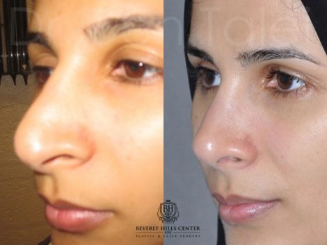 Revision 3rd Rhinoplasty - Left Side