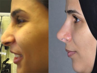 REVISION 3rd Rhinoplasty and reconstruction - Left Side