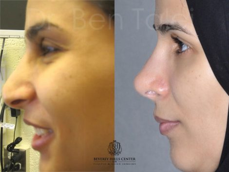 REVISION 3rd Rhinoplasty and reconstruction - Left Side