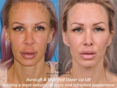 AuraLyft & Modified Upper Lip Lift - Front
