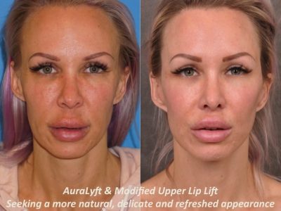 AuraLyft & Modified Upper Lip Lift - Front