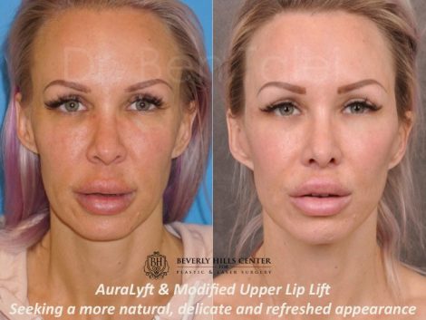 AuraLyft & Modified Upper Lip Lift - Front