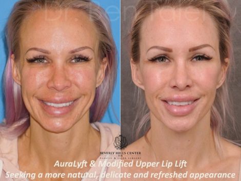 AuraLyft & Modified Upper Lip Lift - Front