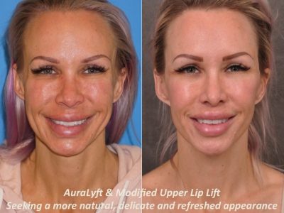 AuraLyft & Modified Upper Lip Lift - Front