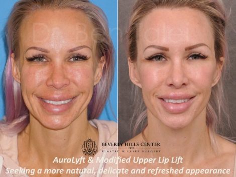 AuraLyft & Modified Upper Lip Lift - Front