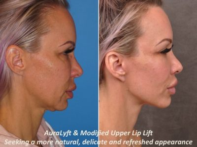 AuraLyft & Modified Upper Lip Lift - Right Side