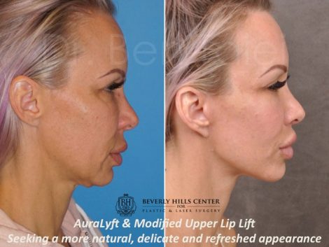 AuraLyft & Modified Upper Lip Lift - Right Side