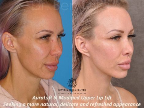 AuraLyft & Modified Upper Lip Lift - Right Side