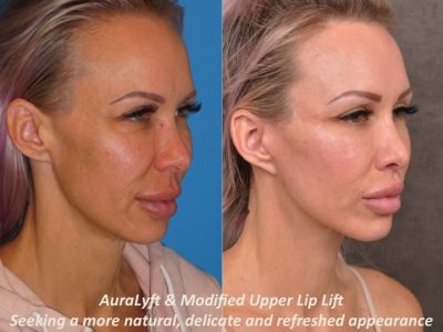 AuraLyft & Modified Upper Lip Lift - Right Side