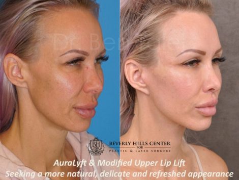 AuraLyft & Modified Upper Lip Lift - Right Side