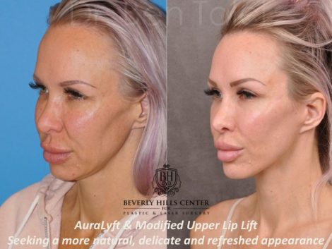 AuraLyft & Modified Upper Lip Lift - Left Side
