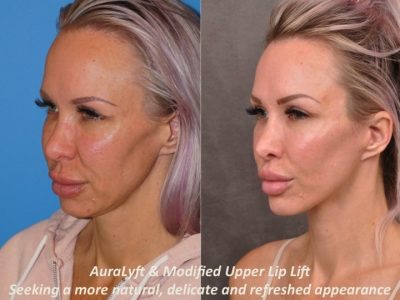 AuraLyft & Modified Upper Lip Lift - Left Side