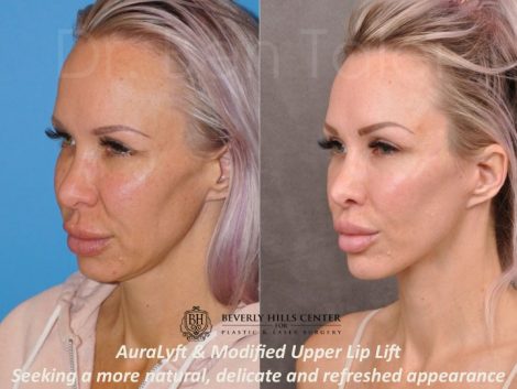 AuraLyft & Modified Upper Lip Lift - Left Side