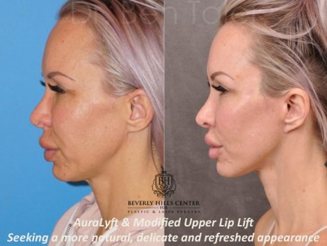 AuraLyft & Modified Upper Lip Lift - Left Side