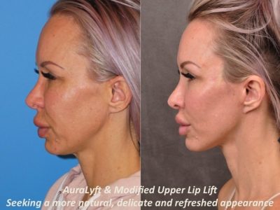 AuraLyft & Modified Upper Lip Lift - Left Side