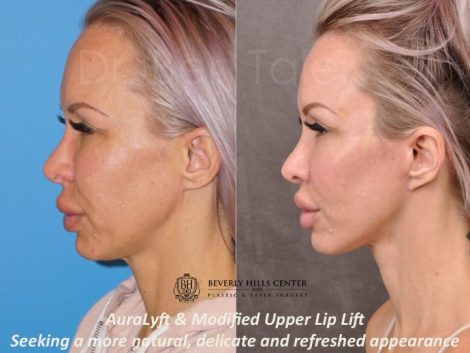 AuraLyft & Modified Upper Lip Lift - Left Side