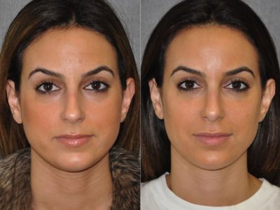 Minimally Invasive 3-D Telescopic Rhinoplasty – Front