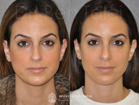 Minimally Invasive 3-D Telescopic Rhinoplasty – Front