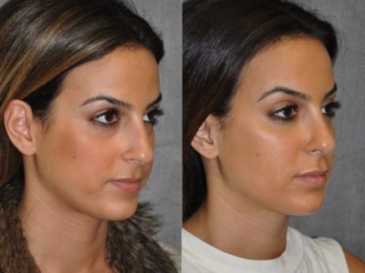 Minimally Invasive 3-D Telescopic Rhinoplasty – Right Side