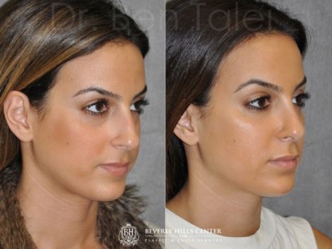 Minimally Invasive 3-D Telescopic Rhinoplasty – Right Side