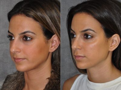 Minimally Invasive 3-D Telescopic Rhinoplasty – Left Side