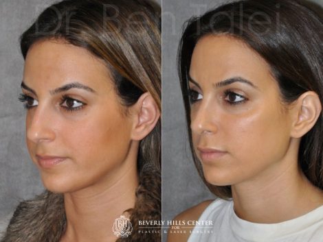 Minimally Invasive 3-D Telescopic Rhinoplasty – Left Side