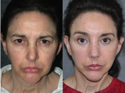 Cheek and Midface Lift - Front
