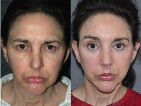 REVISION Rhinoplasty and Septoplasty - Front