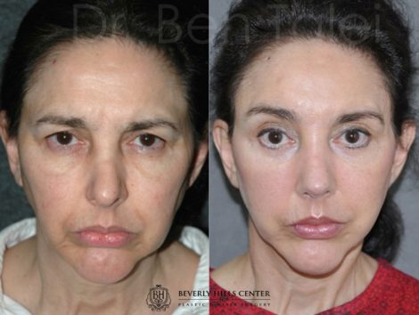 Beverly Hills Center Female Patient Before and After Revision Rhinoplasty and Cheek and Midface Lift