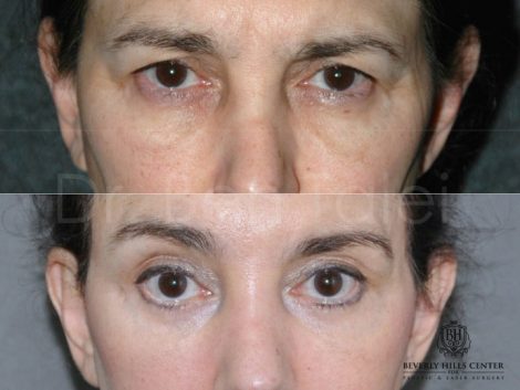 Endosopic Brow Lift - Front