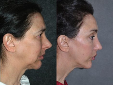 REVISION Rhinoplasty and Septoplasty - Right Side