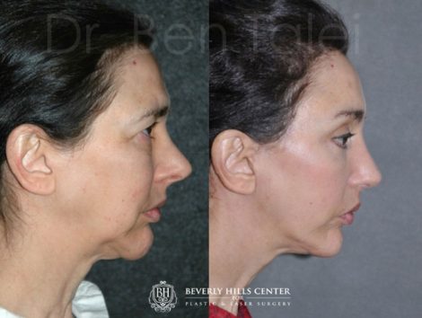 Beverly Hills Center Female Patient Before and After Revision Rhinoplasty and Cheek and Midface Lift