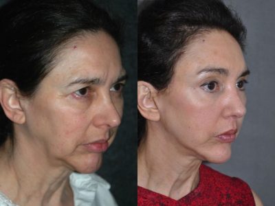 Cheek and Midface Lift - Right Side