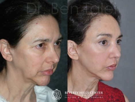 REVISION Rhinoplasty and Septoplasty - Right Side