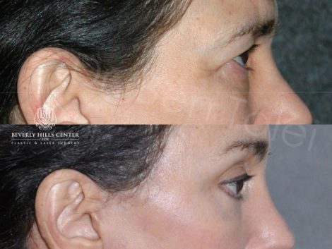 Endosopic Brow Lift - Right Side