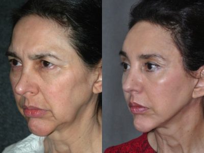Cheek and Midface Lift - Right Side