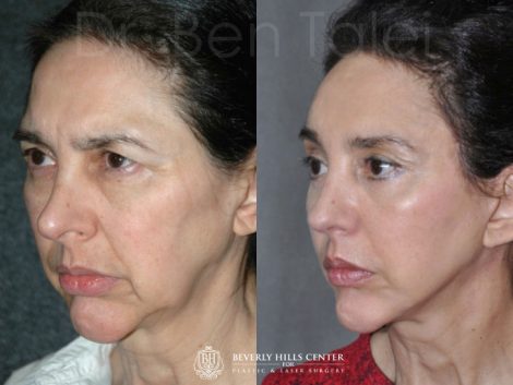 REVISION Rhinoplasty and Septoplasty - Left Side