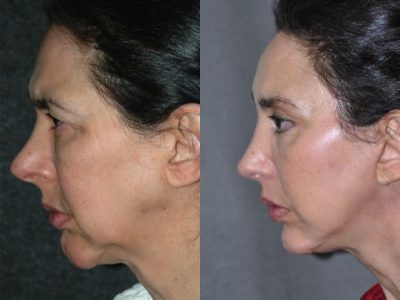 Cheek and Midface Lift - Right Side
