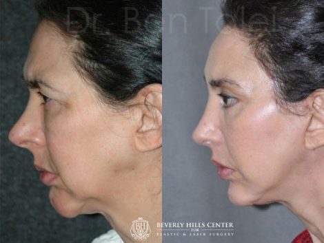 REVISION Rhinoplasty and Septoplasty - Left Side