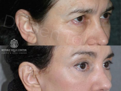 Endosopic Brow Lift - Right Side