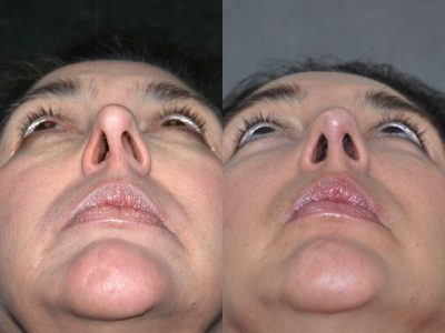 Cheek and Midface Lift - Base