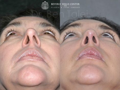 REVISION Rhinoplasty and Septoplasty - Base