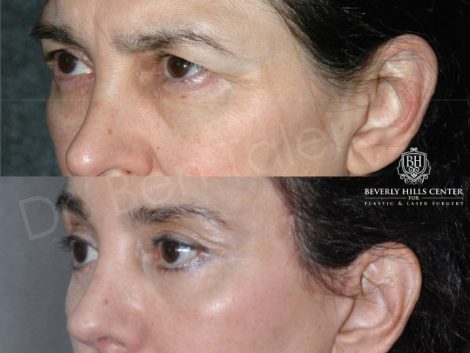 Endosopic Brow Lift - Left Side