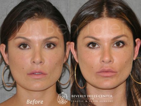 Lip Lift Procedure - Front
